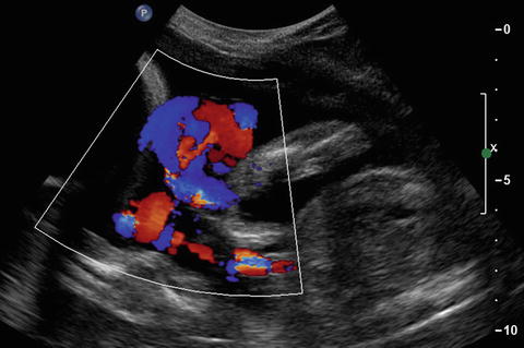 Umbilical cord entanglement, Radiology Case