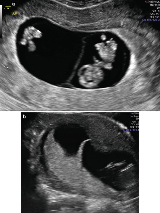 Early Pregnancy Ultrasound
