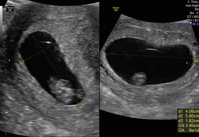 Ultrasound trimester normal first Spontaneous abortion