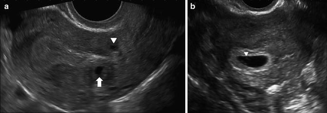 Normal first trimester ultrasound