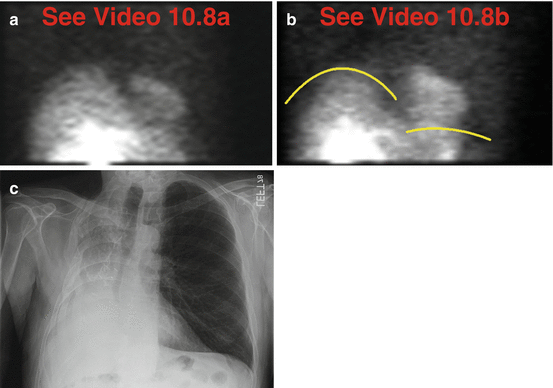 Lungs Radiology Key