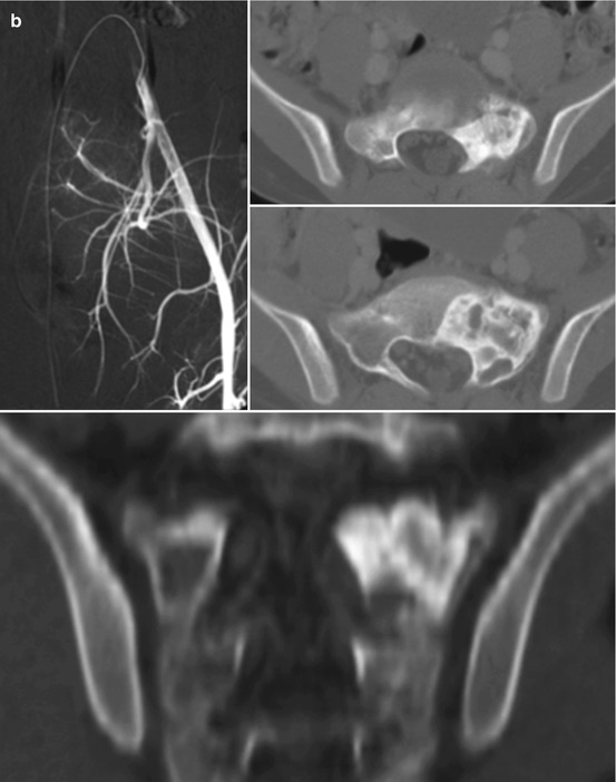 Aneurysmal Bone Cyst Of The Sacrum Radiology Key 9305