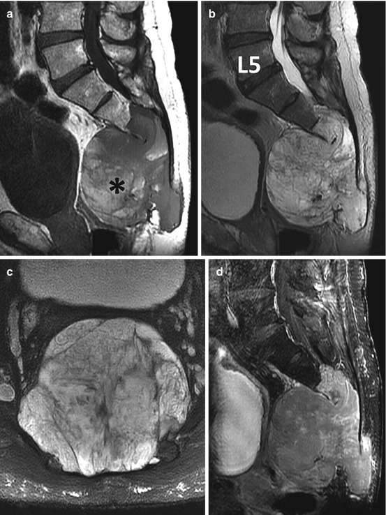 Imaging of Sacral Tumors and Tumor Simulators: Experience of the Mayo