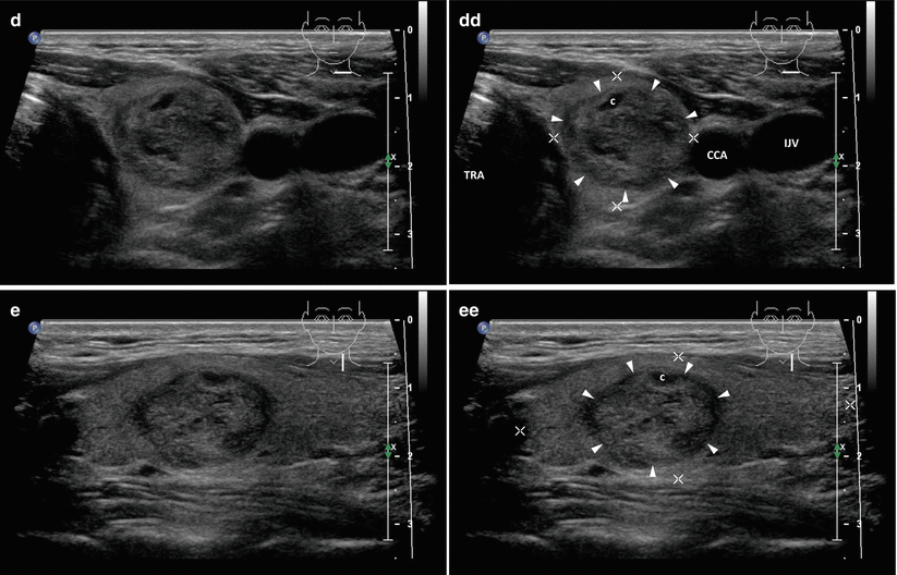 Multinodular Goiter Radiology Key