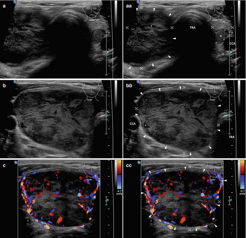 Toxic Multinodular Goiter And Solitary Toxic Adenoma Radiology Key