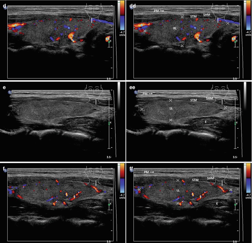 vietnamese-medic-ultrasound-case-338-thyroid-cancer-dr-phan-thanh