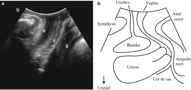 urethral diverticulum ultrasound