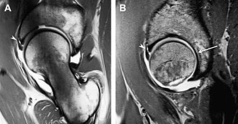 Mri Of Hip Osteoarthritis And Implications For Surgery Radiology Key