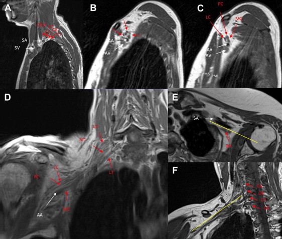 Mr Imaging Of The Brachial Plexus Radiology Key