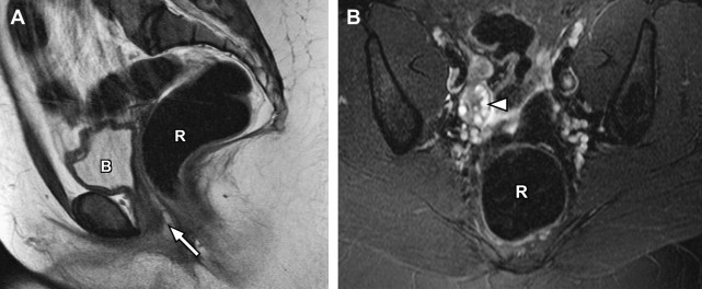 Normal And Variant Pelvic Anatomy On MRI Radiology Key