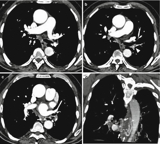 Embolism Radiology Key