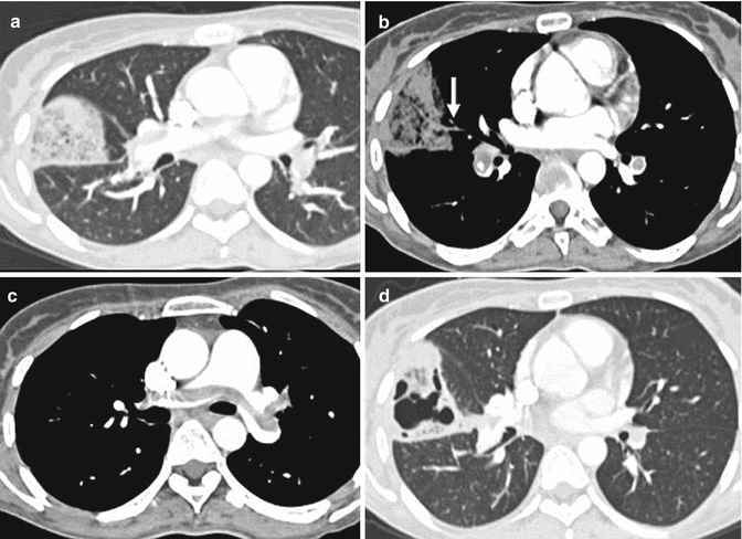 Embolism Radiology Key