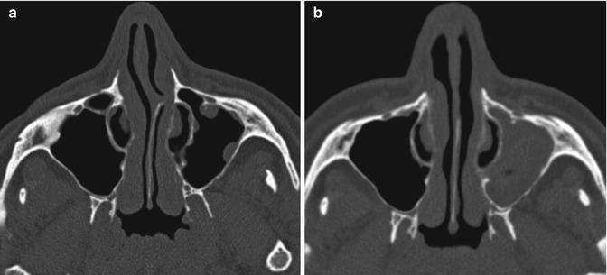 deviated septum xray