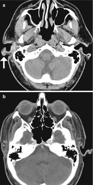 Stapes, Radiology Reference Article