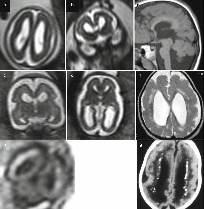 congenital cmv calcifications