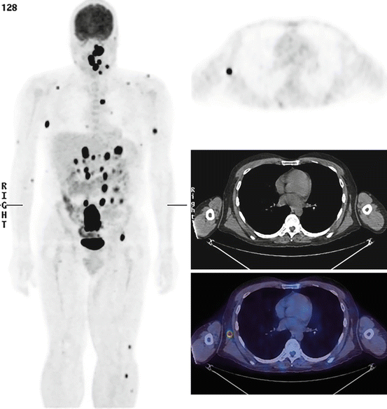 Role of PET/CT in Melanoma | Radiology Key