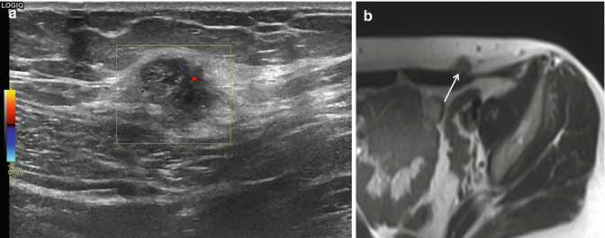 Ultrasound and Color Doppler Ultrasound of Soft Tissue Tumors and Tumorlike  Lesions