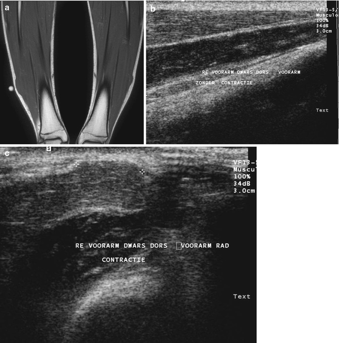 Sternal lesion depicted on screening breast MR images in a 34-year-old