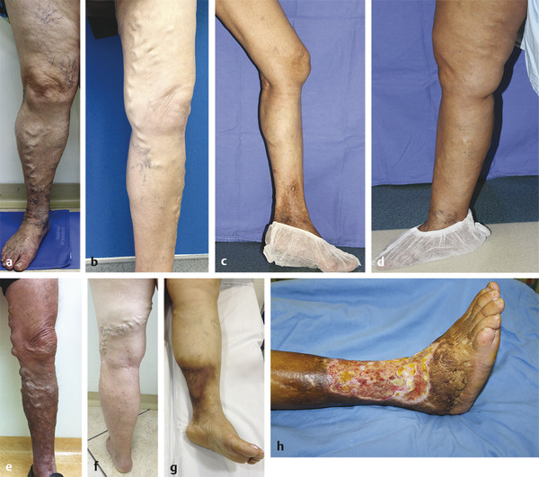 Varicose Veins - Assessment & Treatment