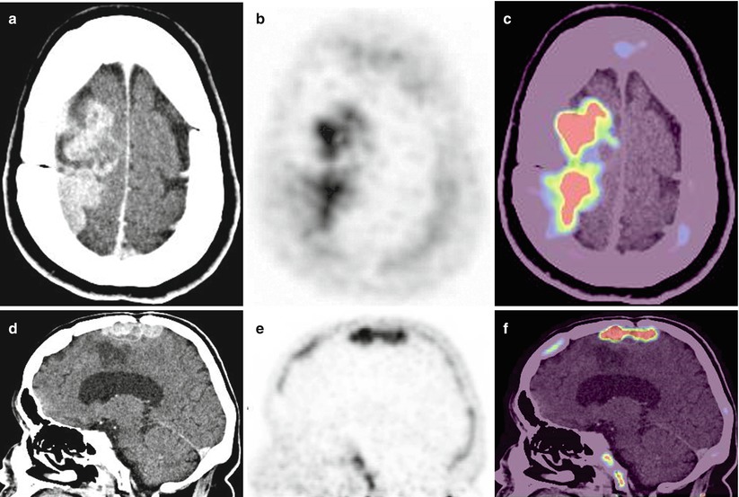 Renal Cell Carcinoma Rcc Radiology Key