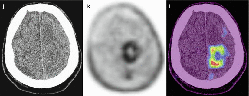 Esophageal Cancer Ec Radiology Key