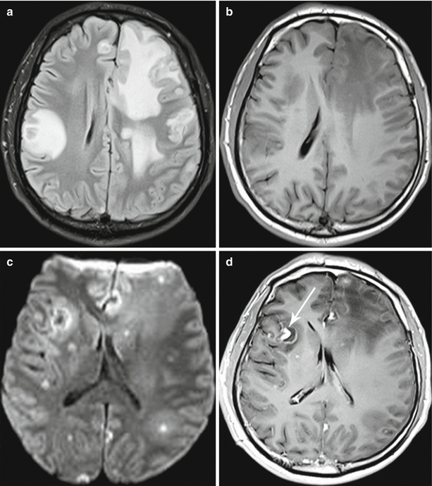 Parasitic Infestations Radiology Key 2987