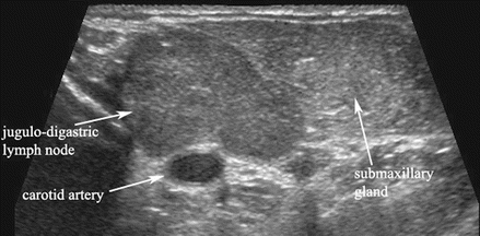 parotid gland tumor ultrasound