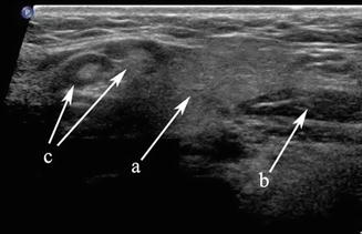 parotid gland swelling ultrasound