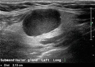 parotid gland tumor ultrasound