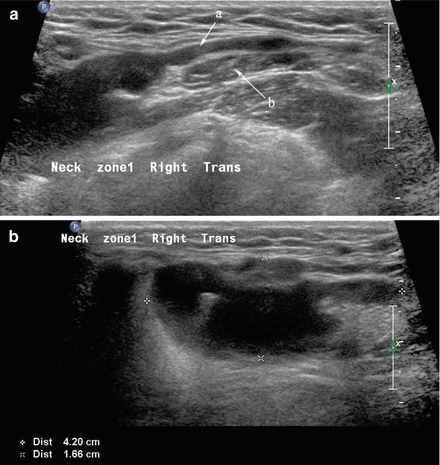 ranula ultrasound