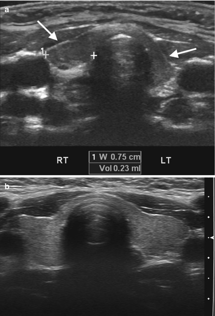 Thyroid Hypoplasia as a Cause of Congenital Hypothyroidism in