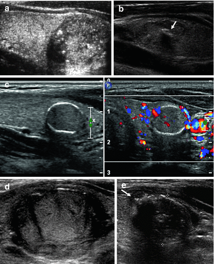 labeled thyroid ultrasound