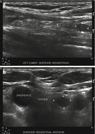 Ultrasonography of the Parathyroid Glands | Radiology Key