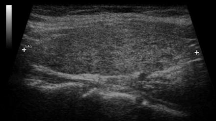 thyroid ultrasound hashimotos