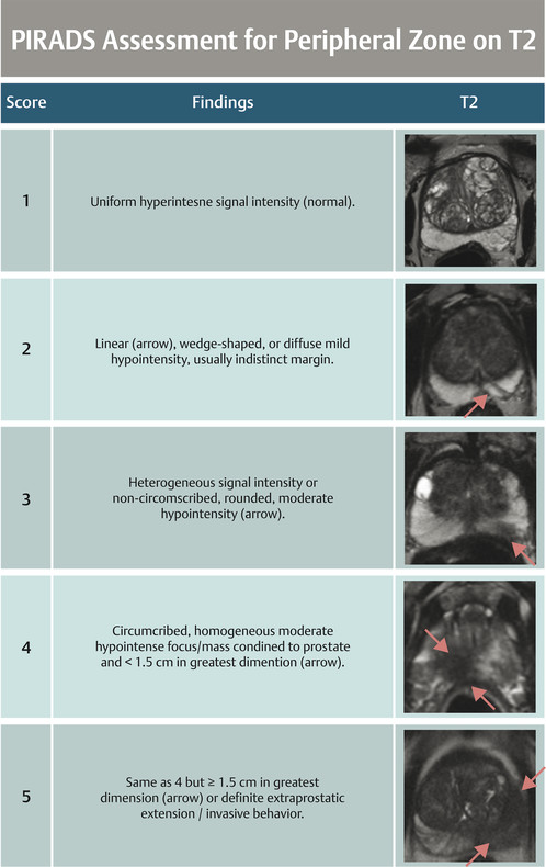 Prostate Imaging Reporting And Data System PI RADS Radiology Key