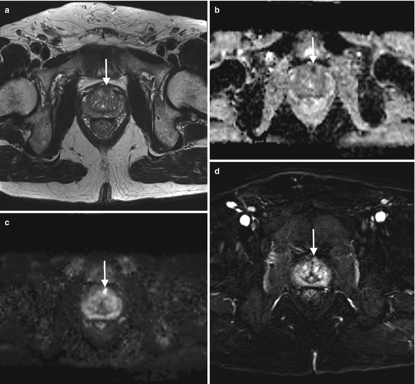 MRI of the Prostate