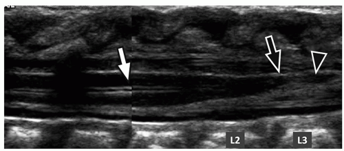 conus medullaris ultrasound
