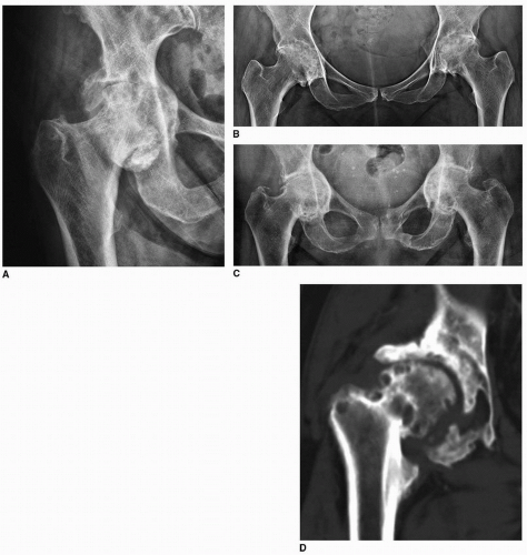 Bilateral central fracture-dislocation of hips after myelography