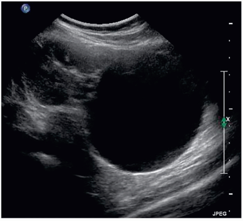 kidney cyst ultrasound and biopsy procedure