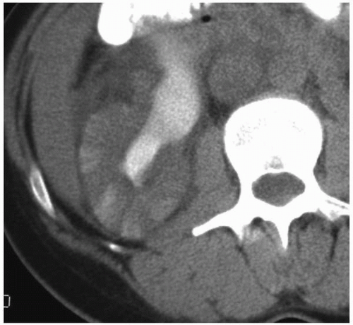 glomerulonephritis ultrasound