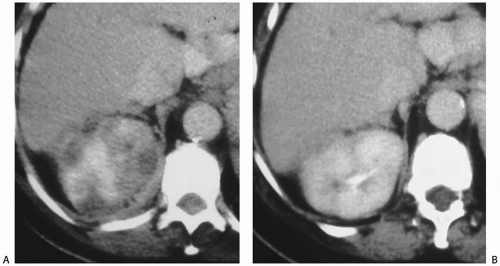 Renal Inflammatory Disease Radiology Key