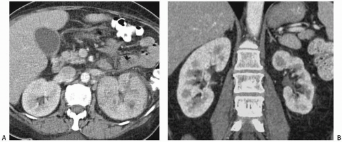 Renal Inflammatory Disease Radiology Key