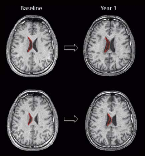 White Matter Diseases And Inherited Metabolic Disorders Radiology Key 9117