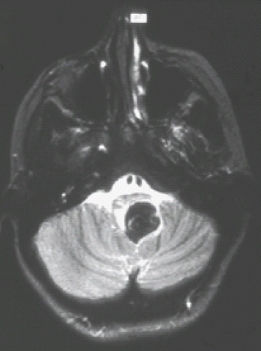 Pediatric Brain Tumors Radiology Key