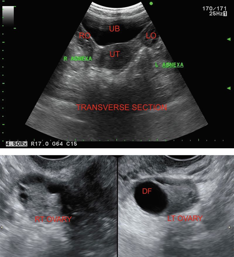 What Does A Normal Uterus Look Like In An Ultrasound What Does A Normal Uterus Look Like In An Ultrasound