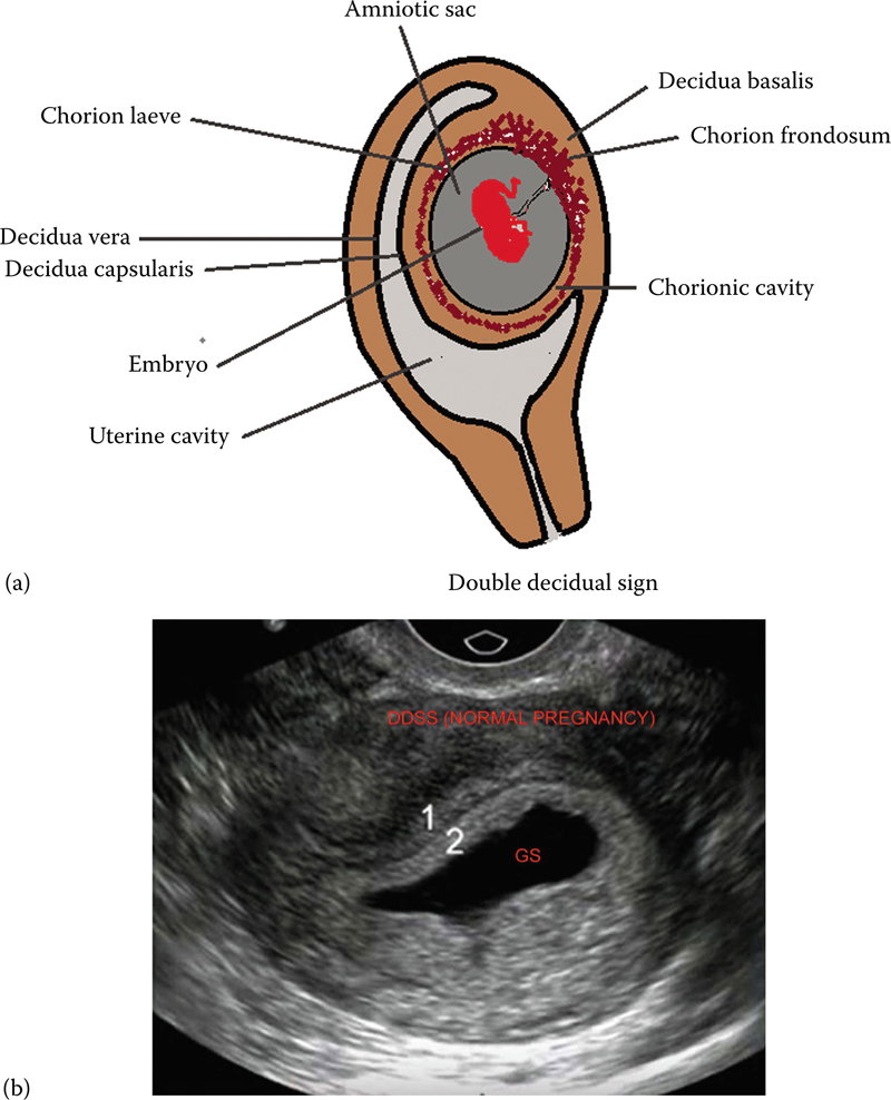 First Trimester Radiology Key 