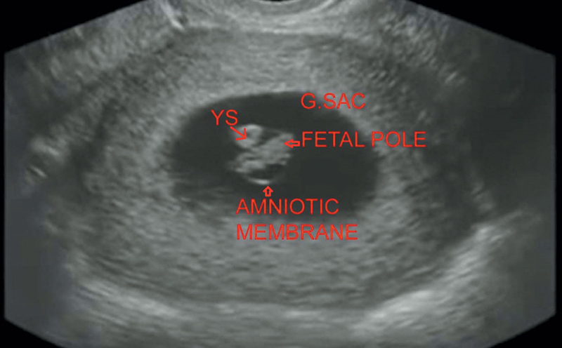 First Trimester Radiology Key