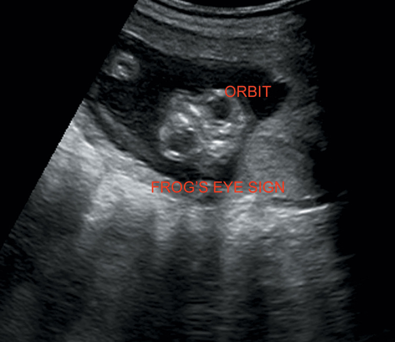 anophthalmia ultrasound