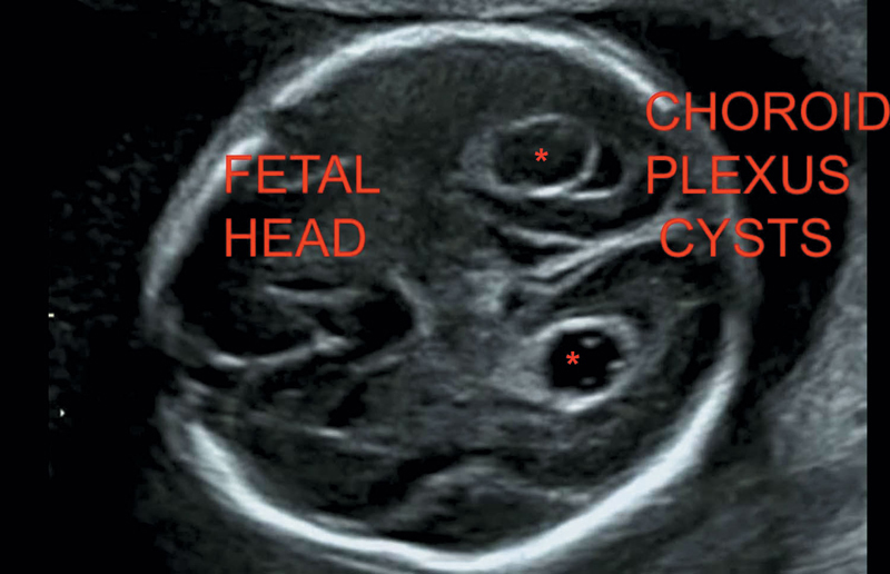 Fetal Malformations Radiology Key 0879