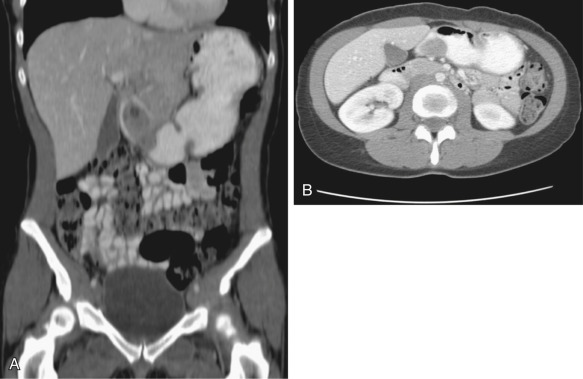 gastric-outlet-obstruction-radiology-key